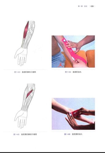 中心医院康复特色 ——肌内效贴之肌肉贴扎技术