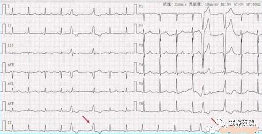 逸搏以早搏形式出现;需要与室性逸搏和室性并行心律鉴别
