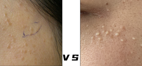 你以为的脂肪粒其实是个肿瘤