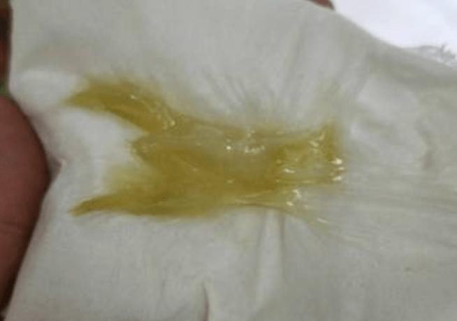 19岁女孩患宫颈癌晚期,只因1事感染hpv,医生:年轻人也