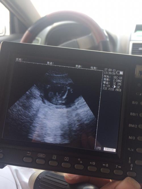 4个月做的b超,说是男孩,准么