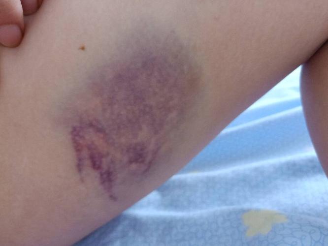 腿上摔的淤青怎么去除,有点肿了