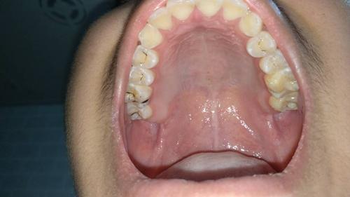 还有就是有蛀牙能不能当兵,第二张图是上面,第三张是下面牙齿.