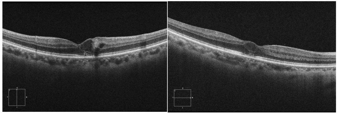 oct:右眼黄斑水肿较前稍好转iva第二针术后1个月复诊