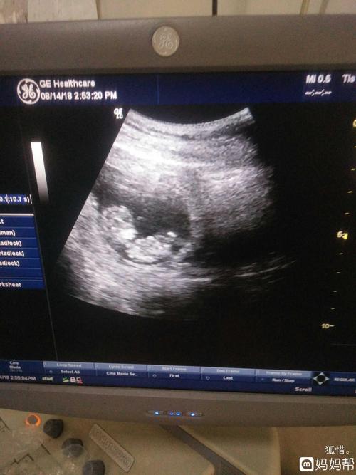 医生说已经十一周了
