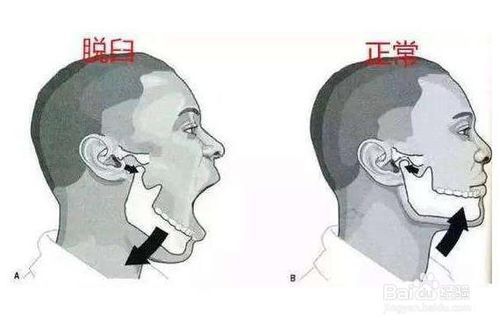 怎样自我处理下巴脱臼