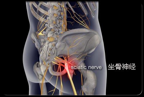 但有时突出或破裂的椎间盘压迫到坐骨神经,疼痛会从臀部放射至腿部