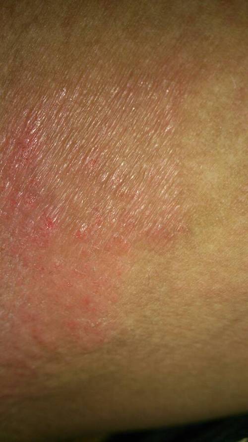 请问这是湿疹还是股藓 需要什么药物治疗