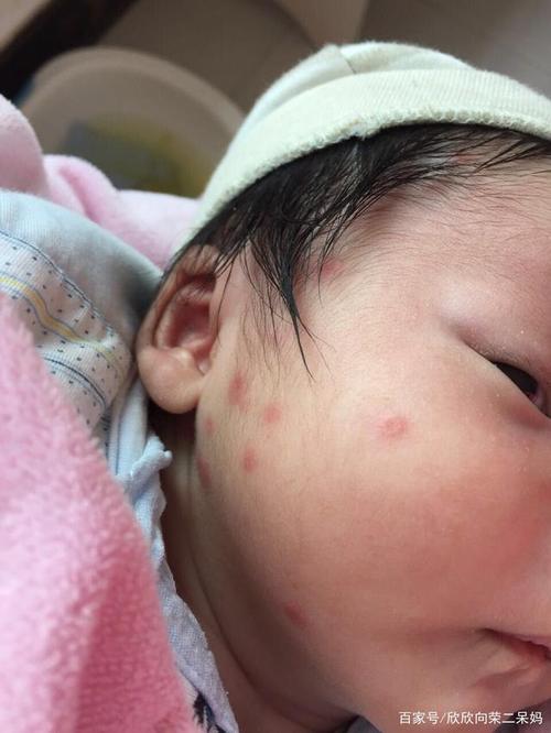 小宝宝被蚊子叮咬都是红点