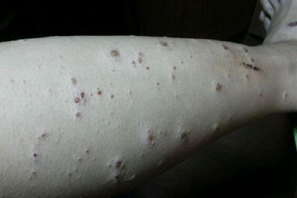 疥疮是怎么引起的