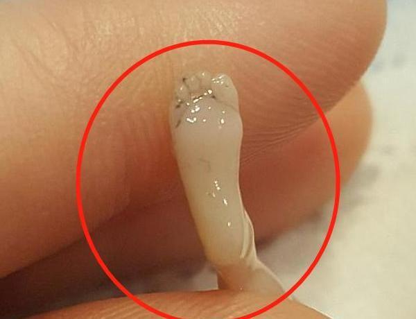 原创女子怀孕14周流产,胎儿原图曝光!长度仅10厘米但手脚已成型