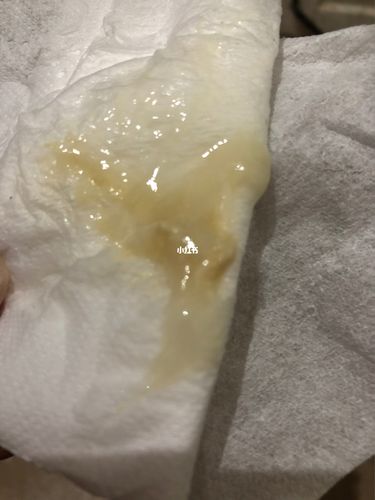 这是用第一粒药丸排出来的,真实图片._宫颈糜烂_医疗健康_医疗药品