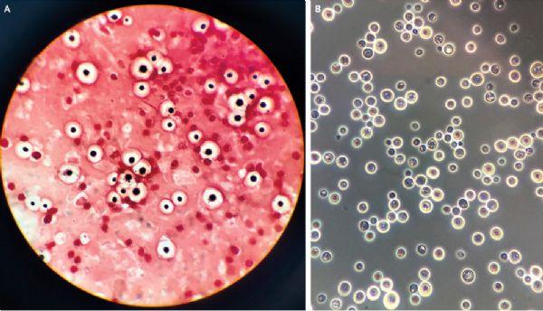 nejm:新型隐球菌脑膜脑炎-病例报道