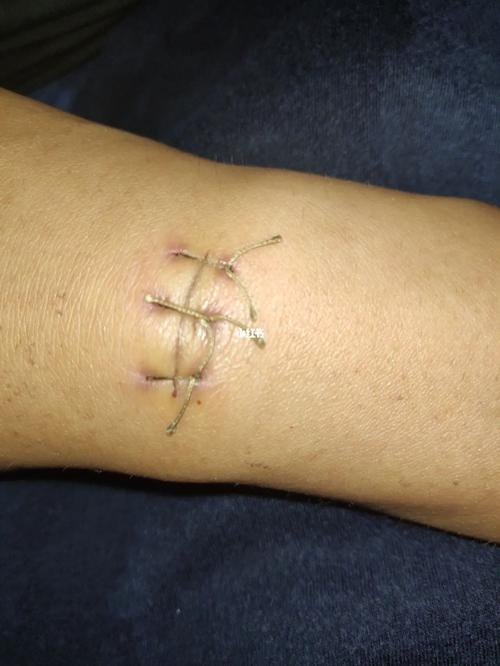 腱鞘囊肿手术_暑假_护士_腱鞘囊肿_医疗健康_医疗健康