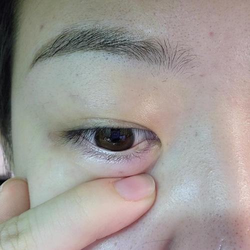 下睫毛内翻被皮挡住完全夹不出来应该怎么处理