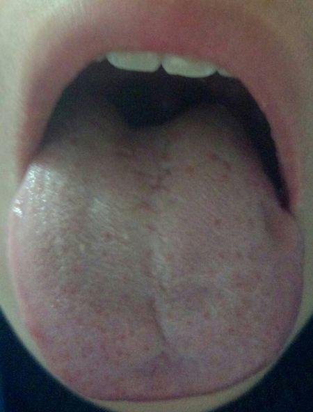 偶尔鼻涕中带血是不是鼻咽癌?