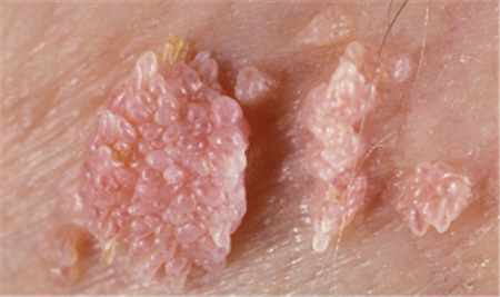 尖锐湿疣的早期症状有哪些不同类型不同分析