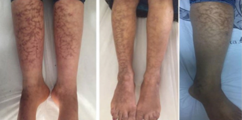 警惕取暖不当可能引起火激红斑