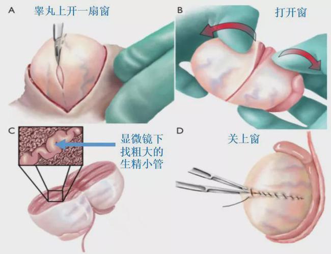让无精子症患者圆梦生娃的睾丸手术