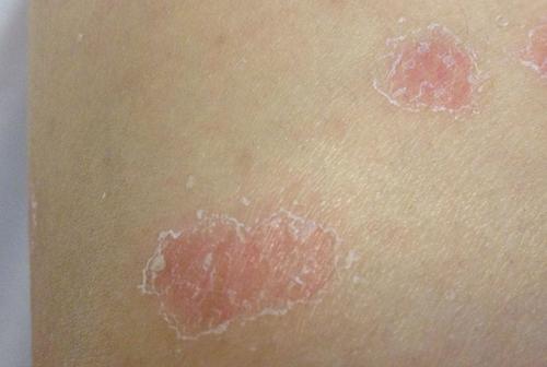 两者不是一回事,它们的症状分别为: 皮癣呈边界清楚的斑片,表面覆盖