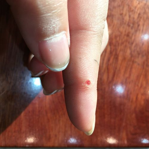手指上莫名其妙长了个包,以为是刺,挑开看什么都没有啊,朋友说是鸡眼
