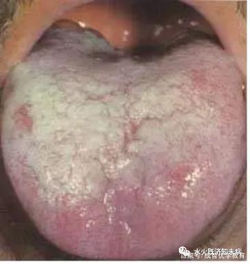 舌诊有多准确你知道吗舌诊图谱详解