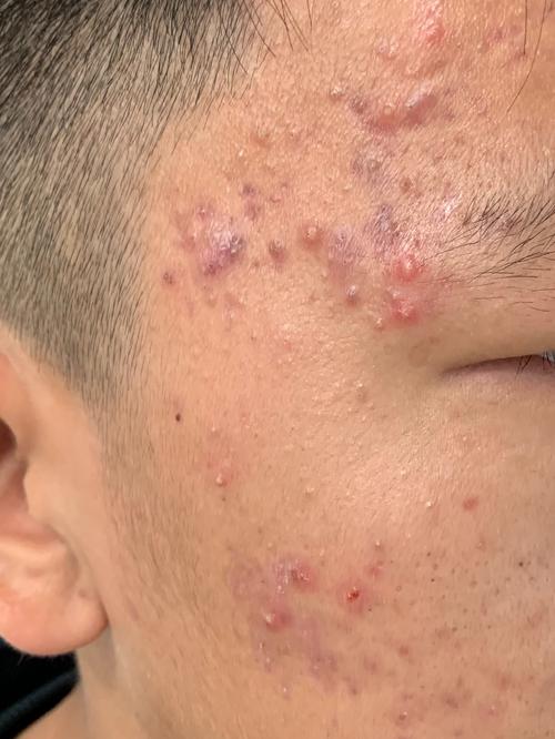 青少年痤疮(痘痘)能治吗?