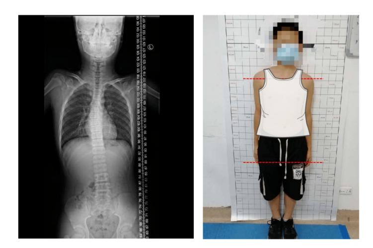 脊柱侧弯严重影响青少年的身心健康,如果不进行治疗干预,不但会引发