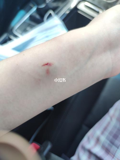 记录被狗咬伤后去疤痕_疤痕_去疤_男朋友_皮肤医院_药膏_疤痕疙瘩