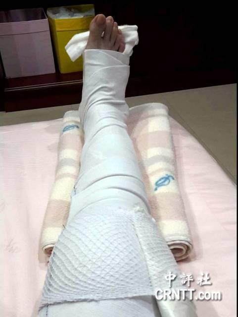 高雄绿议员林莹蓉遭飞车冲撞膝盖骨折