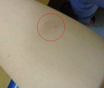 请问这是不是艾滋病的早期症状