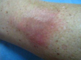 其临床特点为胫前出现大片黄色硬韧的斑块,部分患者伴有糖尿病. /p>