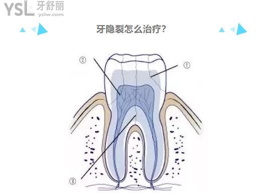 关于:牙隐裂的牙齿不治疗可以用多少年?该怎么保养?必
