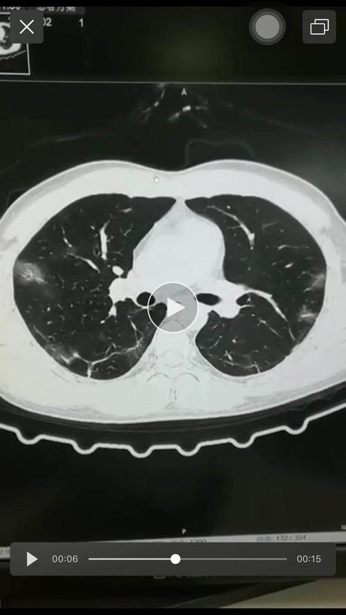因为大众已了解到,新冠病毒感染后肺部ct会出现斑片状磨玻璃影