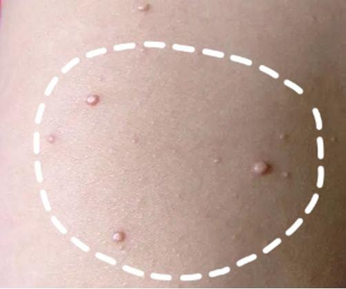 大小长期不变,假性湿疣无传染性,不是性病,主要与阴道分泌物长期刺激