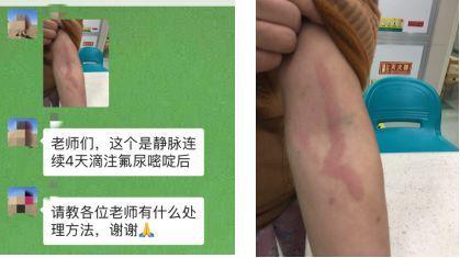 治疗静脉炎方法大全,果断收藏!_化疗