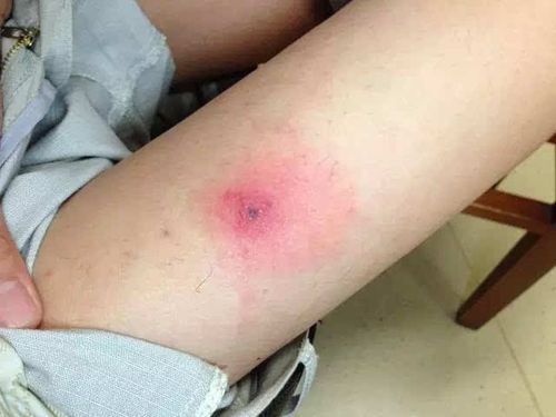 这是蜘蛛咬伤的表现,估计是在河岸被树丛里的蜘蛛咬伤的