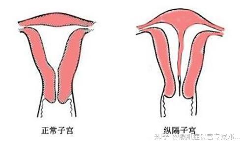 纵膈子宫患有子宫腺肌症的该怎么治疗