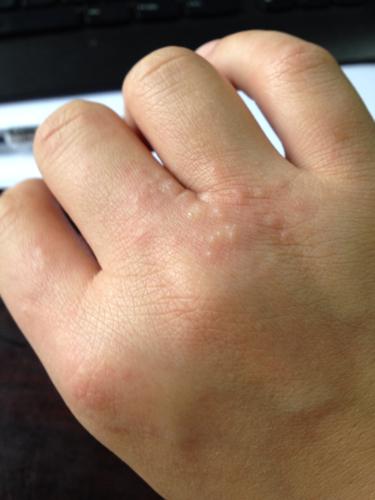 手指总长这样的小水泡,不会破,很痒,怎么办