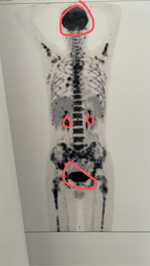 跪求有经验的看下我父亲的petct到底如何