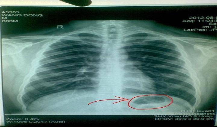 体检时女性很多都不想做"胸透",医生到底能看到什么?原来如此