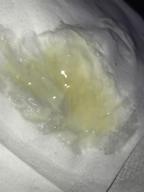 请问一下我这个精子是什么回事?