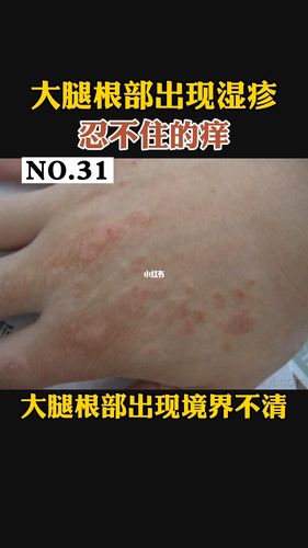 大腿根部湿疹,怎么办?_湿疹_广州攻略_医疗健康_医疗