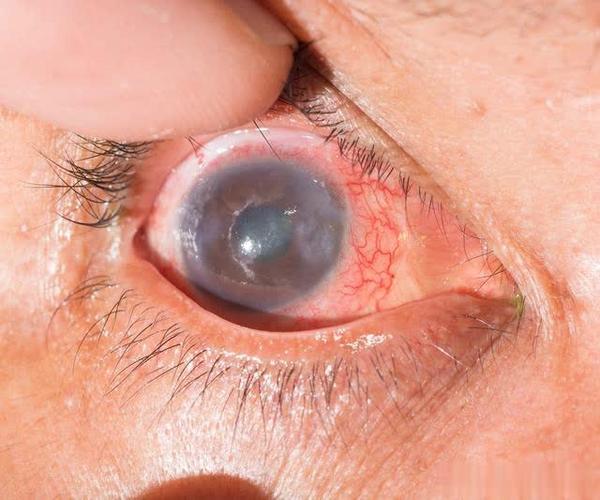 爱吃葡萄的你知道眼睛还有一种病叫做葡萄膜炎?