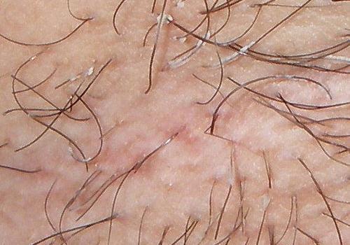 肛门湿疹和癣的区别 五种区别教你分辨湿疹和癣