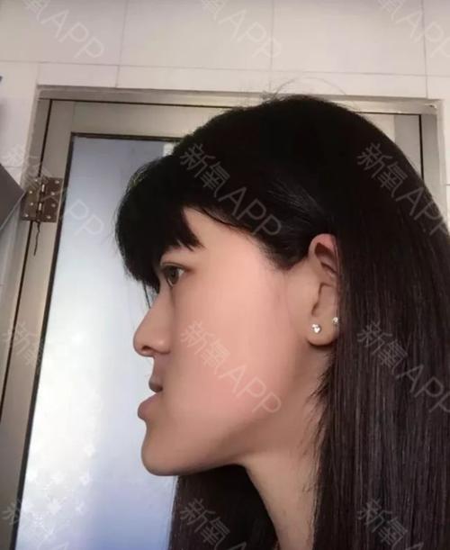 地包天,正畸 正颌手术,九院史俊,手术费不到八万