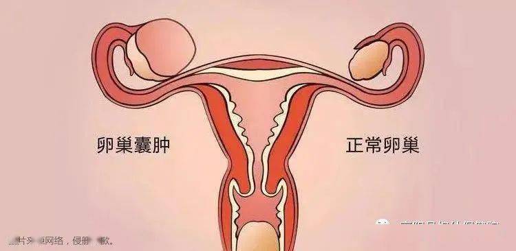 【高阳妇幼女性健康】关于卵巢囊肿