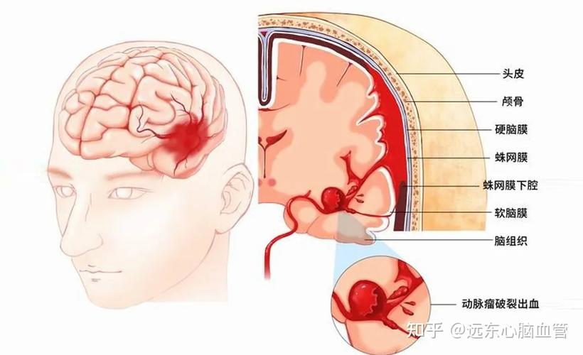 突发头痛警惕蛛网膜下腔出血