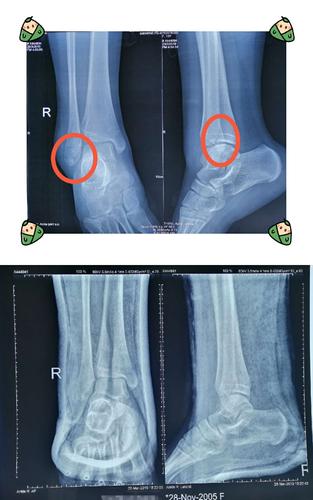 女孩,13岁,右外踝骨折