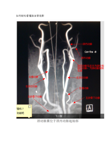 如何轻松看懂脑血管造影颈内动脉dsa(正常)